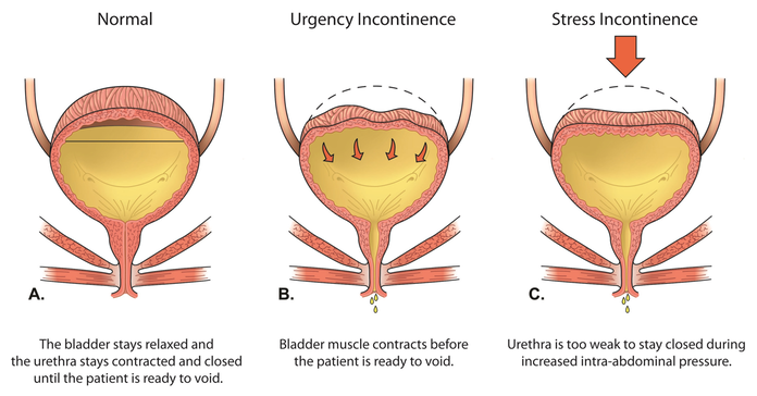 stress incontinence & urinary incontinence